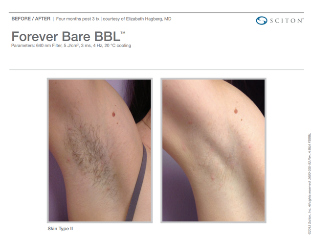 Laser Hair Removal BBL Forever Bare Albany OR Pure Beauty